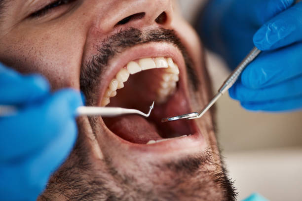 Best Emergency Dentist for Lost Fillings or Crowns in Bicknell, IN
