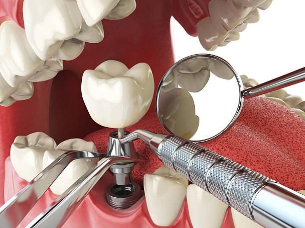 Best Emergency Dental Extractions in Bicknell, IN